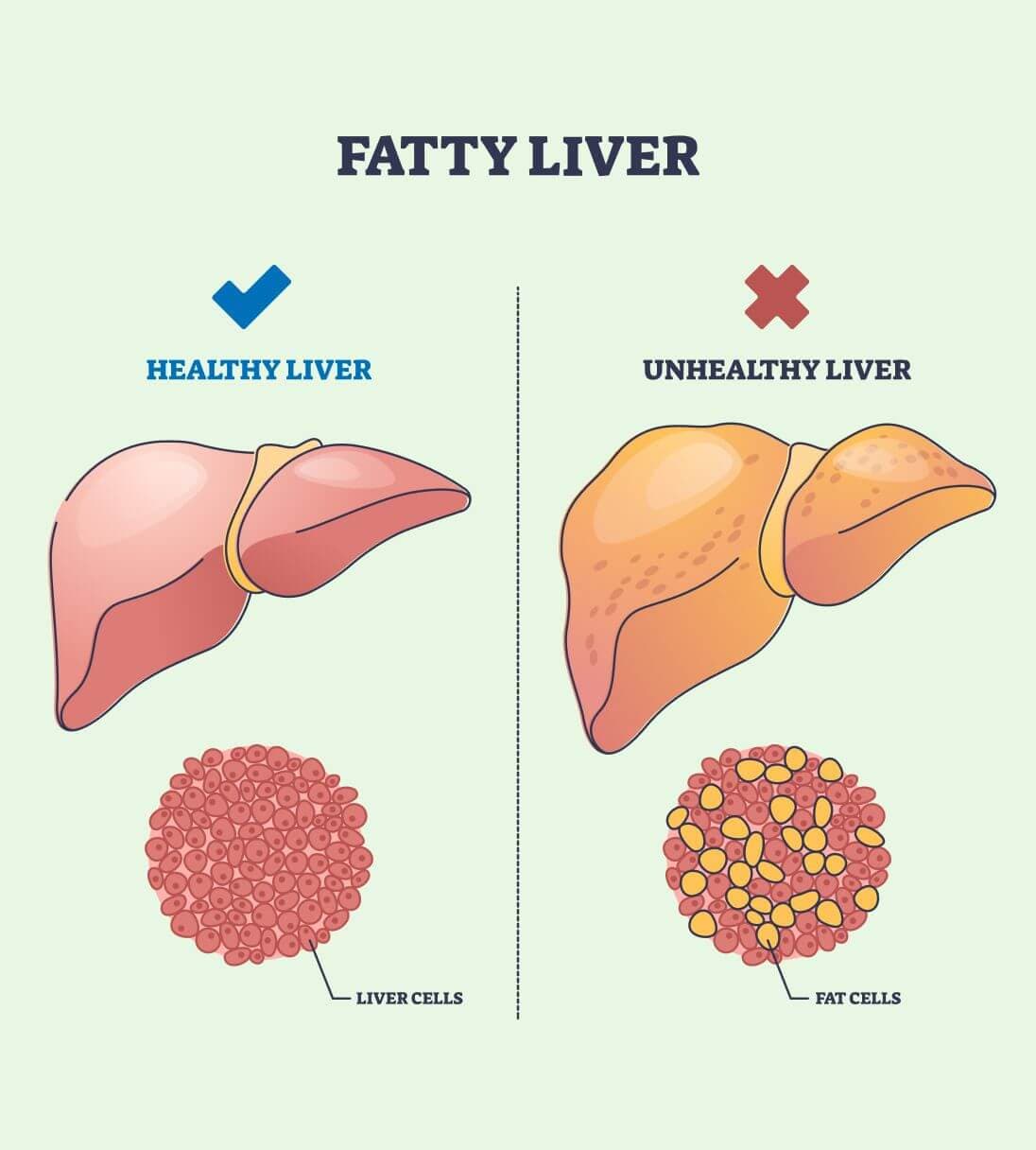 Fatty liver